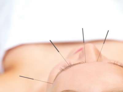 Akupunktur
